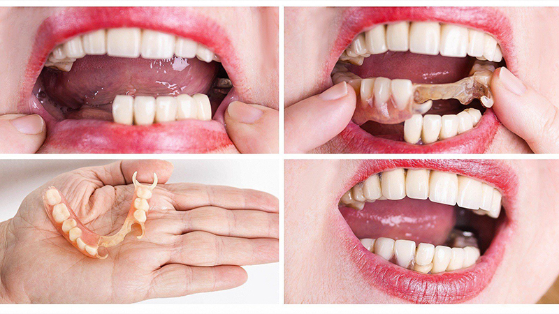 أطقم الأسنان الجزئية - مستوصف سكن اند تيث الطبي