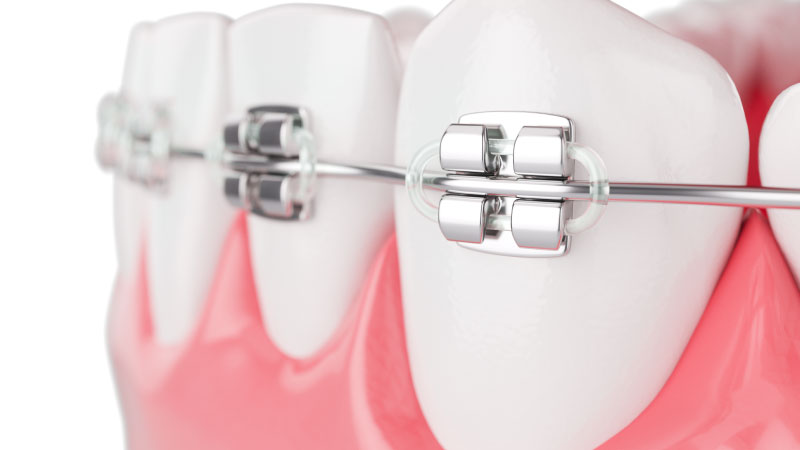 تقويم الأسنان المعدني - مستوصف سكن اند تيث الطبي