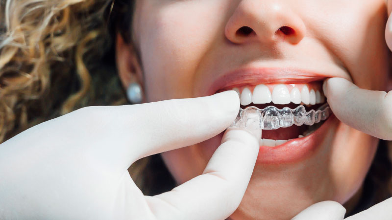 تقويم الأسنان الشفاف (الانفزلاين) - مستوصف سكن اند تيث الطبي